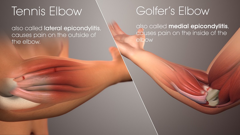 Golfer's Elbow and Tennis Elbow Location Differences