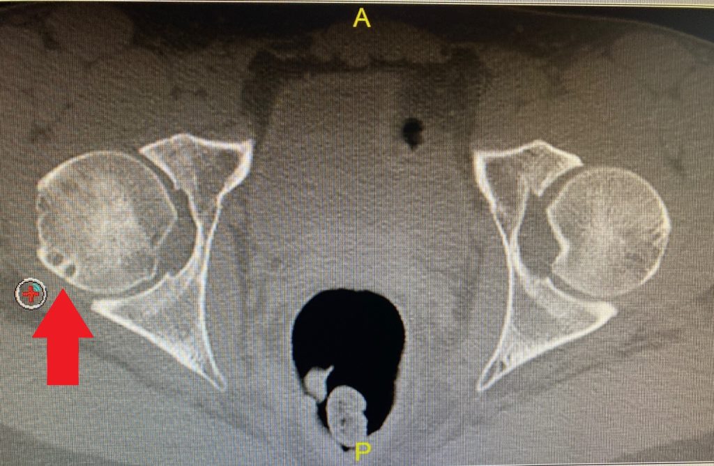 Cysts appear on the left side of the CT scan in the femoral head