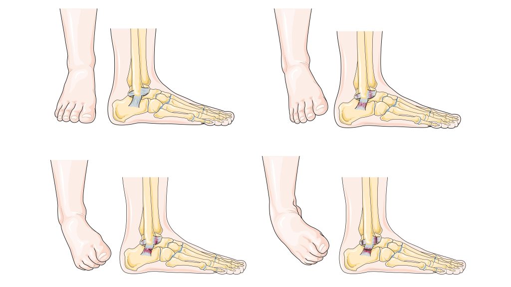 Ankle Sprain Strengthening Exercises