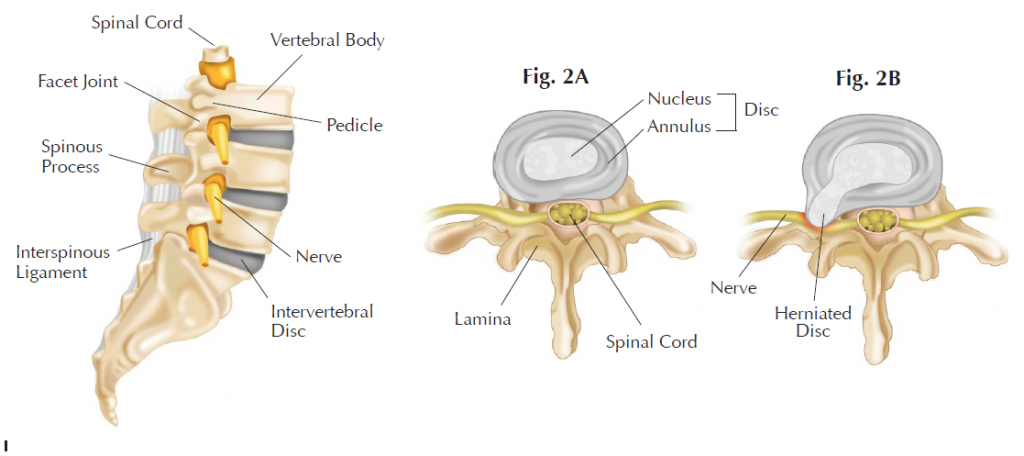 lumbar-slipped-disc-treatment-specialized-physical-therapy