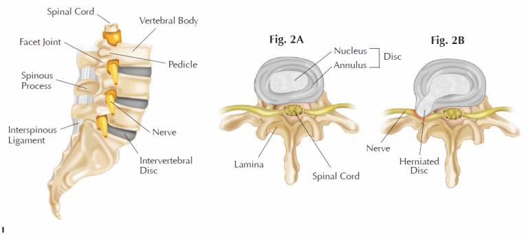 Lumbar Slipped Disc Treatment - Specialized Physical Therapy