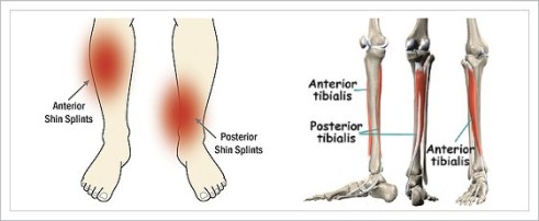 Shin splints can occur on the outside and inside of the lower leg